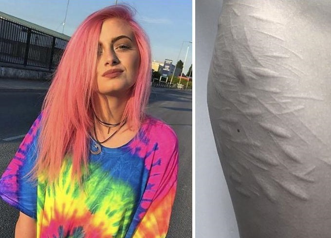 Vagdosta magát a 19 éves lány - a tetoválók nem akarták elvállalni a hegek kivarrását