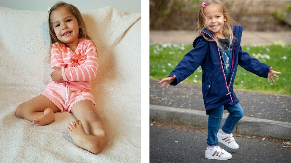 Két éve amputálni akarták a lábait, mégis megtanult járni a 3 éves kislány