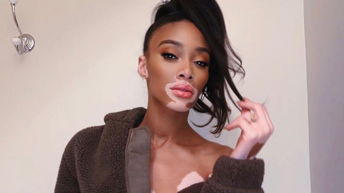 Winnie Harlow félmeztelen fotója nem túl életszerű