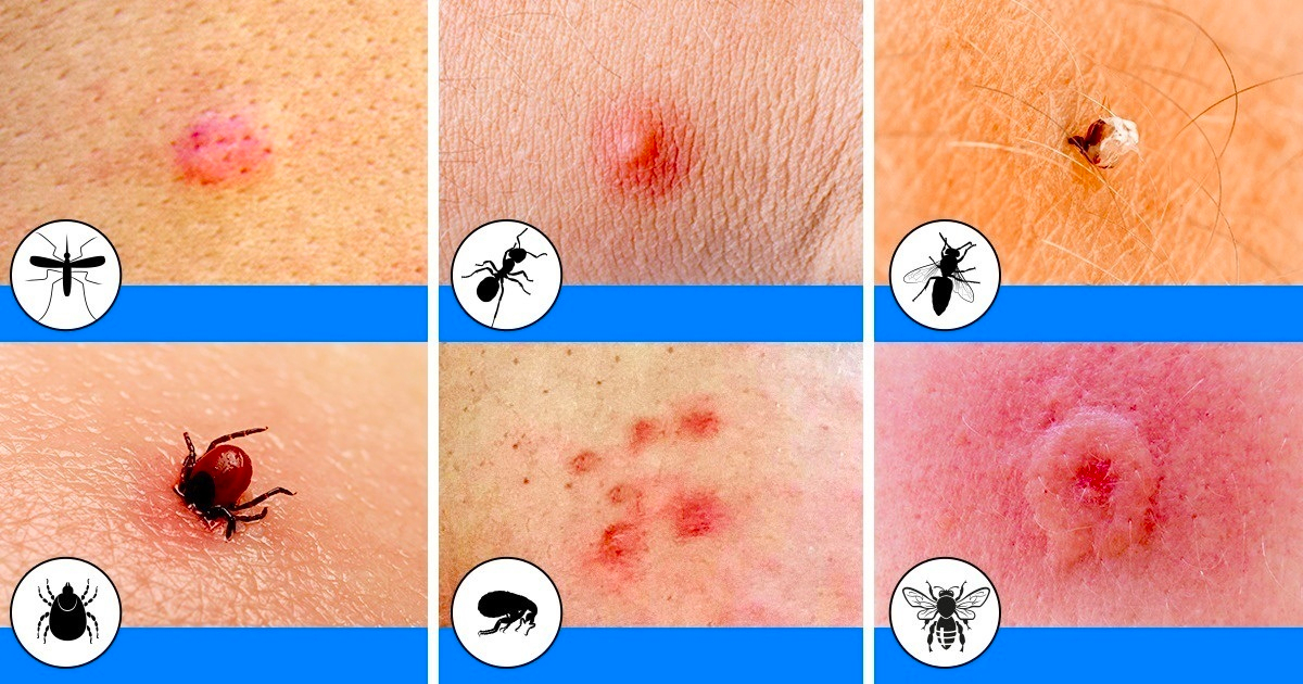 10 fajta rovarcsípés, amit mindenkinek fel kellene ismernie