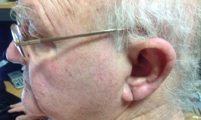 Frank-jegy: a függőleges barázda a fülcimpán, ami komoly betegségre utalhat