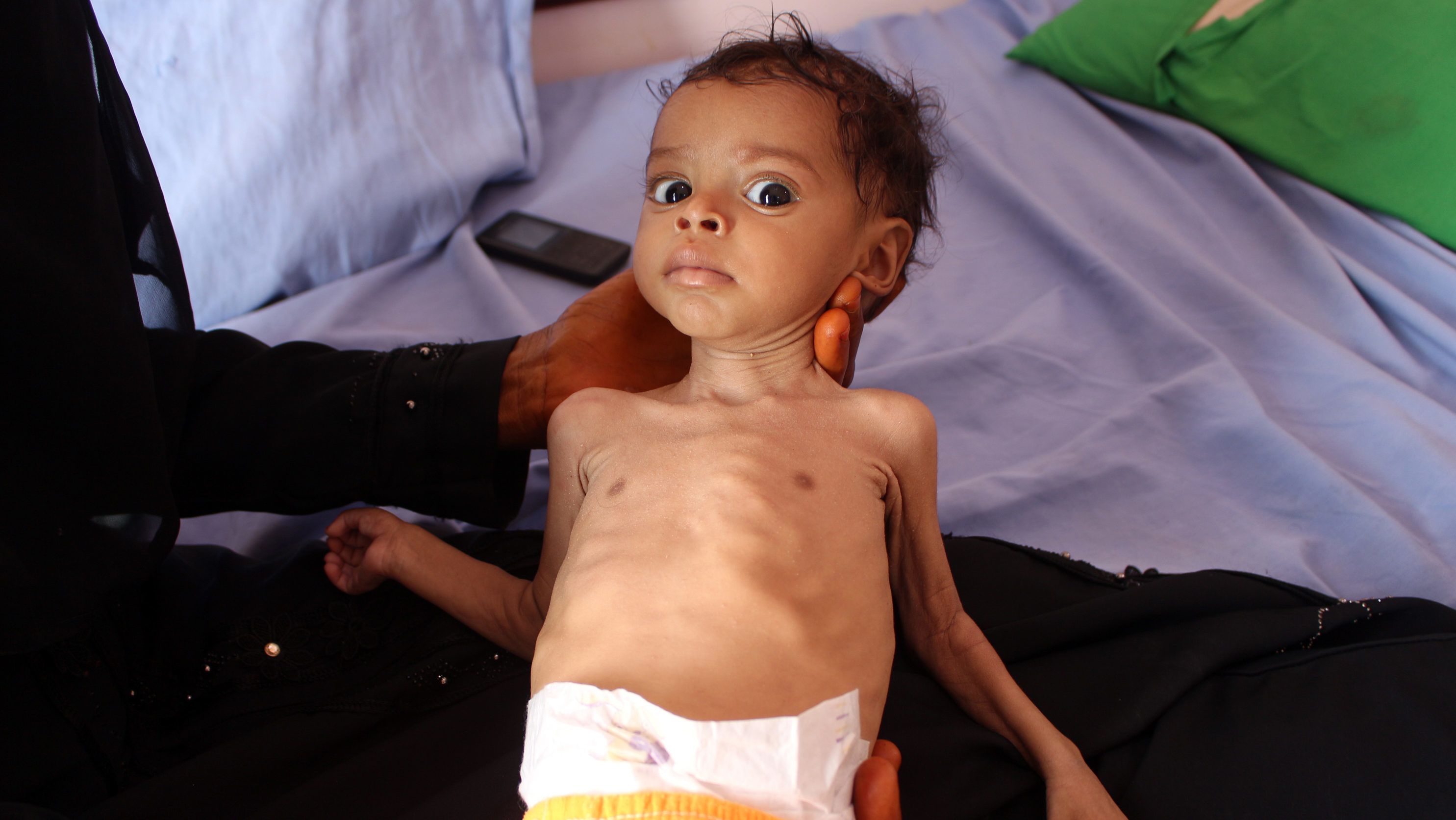 Ha ma véget érne a háború, az éhező jemeni gyerekekre akkor is 20 év szenvedés várna