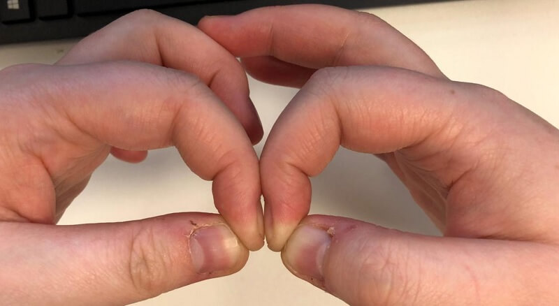 Ki lehet szűrni a rákbetegséget az ujjaink segítségével?