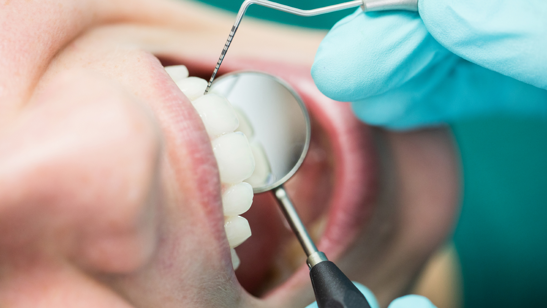 Szándékosan rongálta páciensei fogait egy amerikai fogorvos