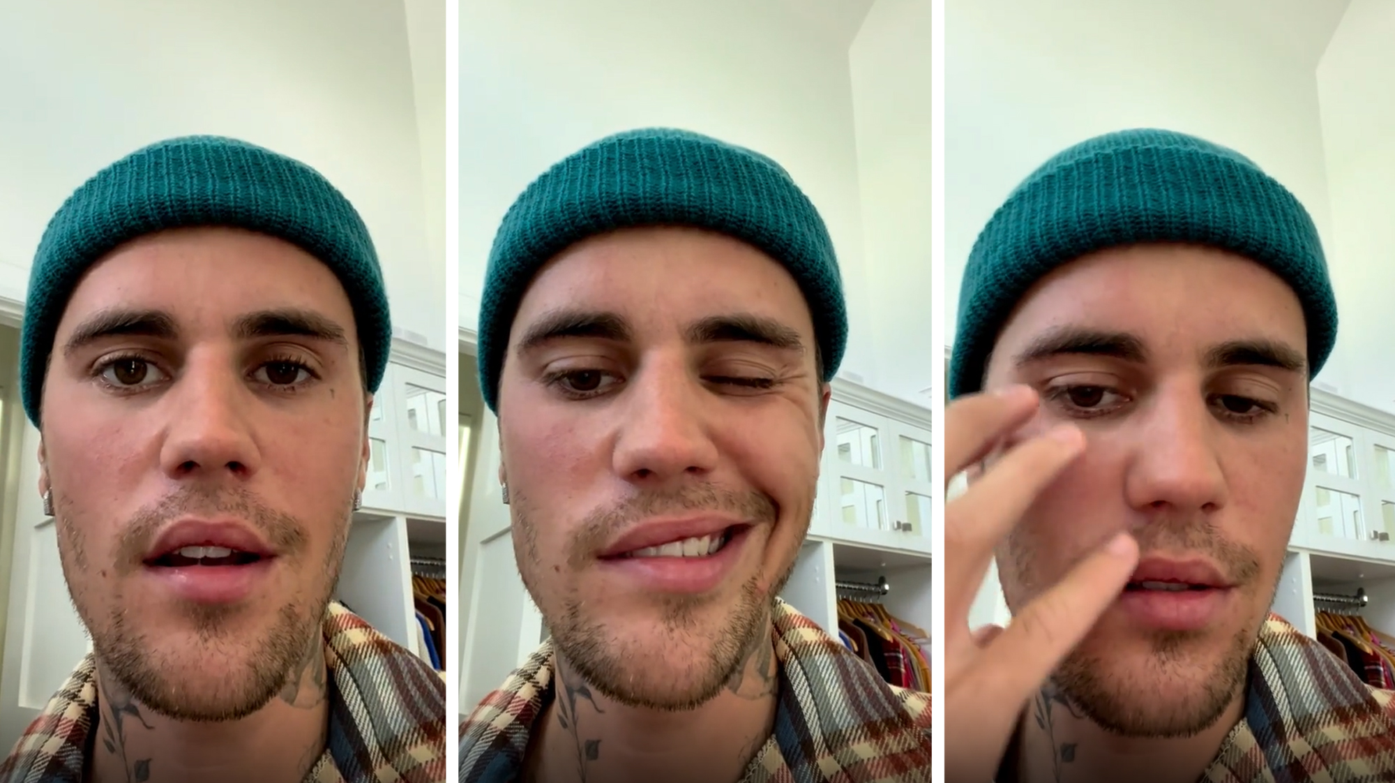 Sokunkban ott a vírus, amitől lebénult Justin Bieber fél arca