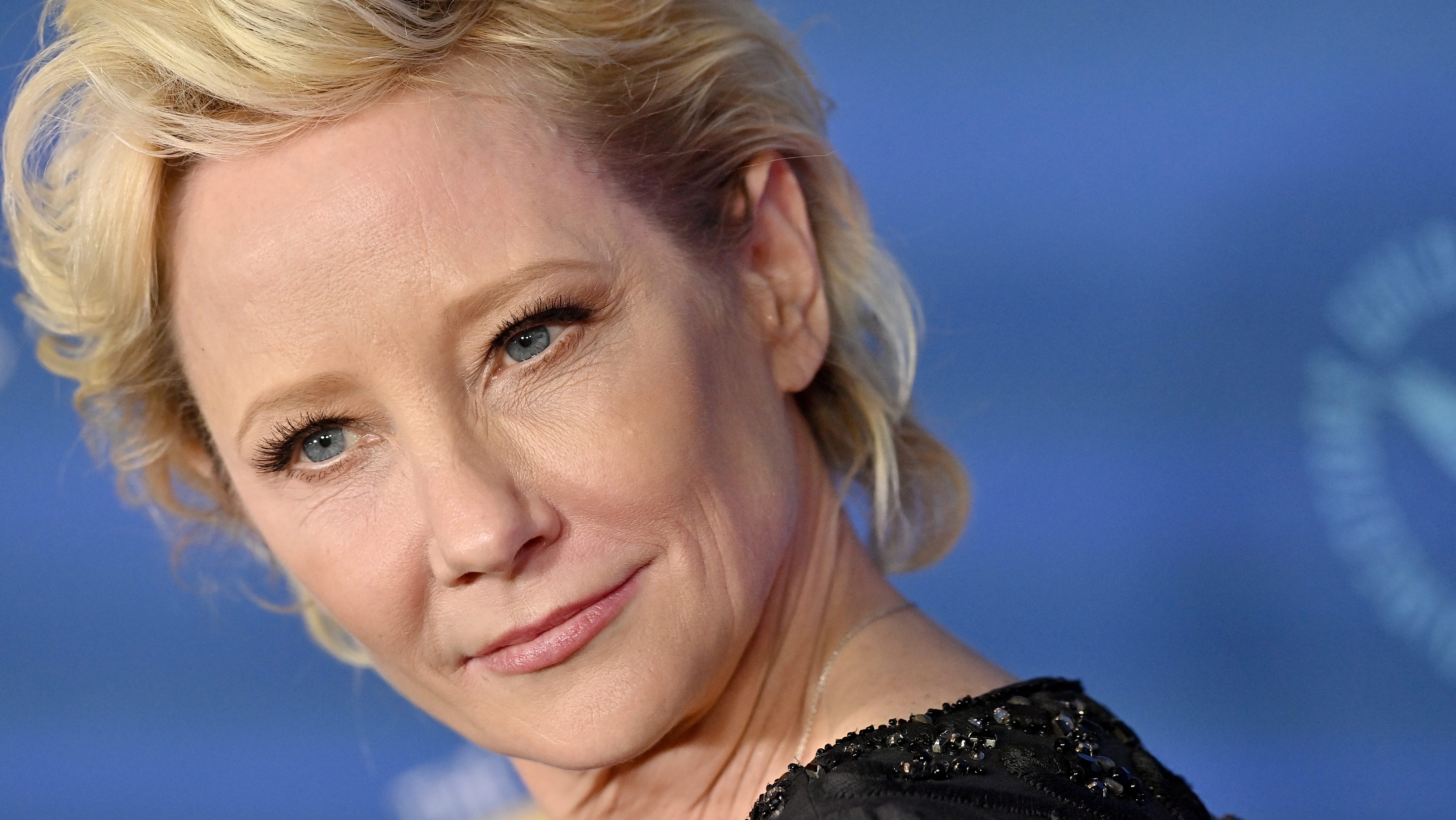 Anne Heche kómában van, és lélegeztetőgépre került súlyos tüdősérülése miatt