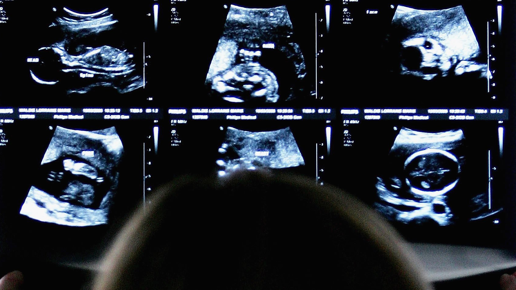 Féláron kérhetik az abortuszt a nyugdíjasok és a beteg bányászok