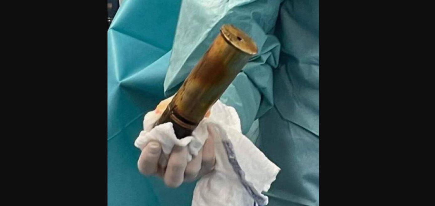 Ilyet még nem láttak az orvosok: egy 88 éves férfi egy első világháborús bombát dugott fel a végbelébe