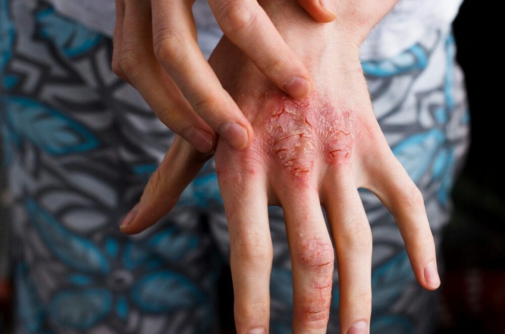 Allergiás lett a saját könnyeire és verejtékére egy 11 éves lány egy rejtélyes bőrbetegség miatt